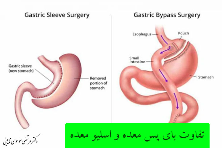 آیا لیپوماتیک خطرناک است+قبل از عمل لیپوماتیک چی بخوریم+اسلیو معده یعنی چی