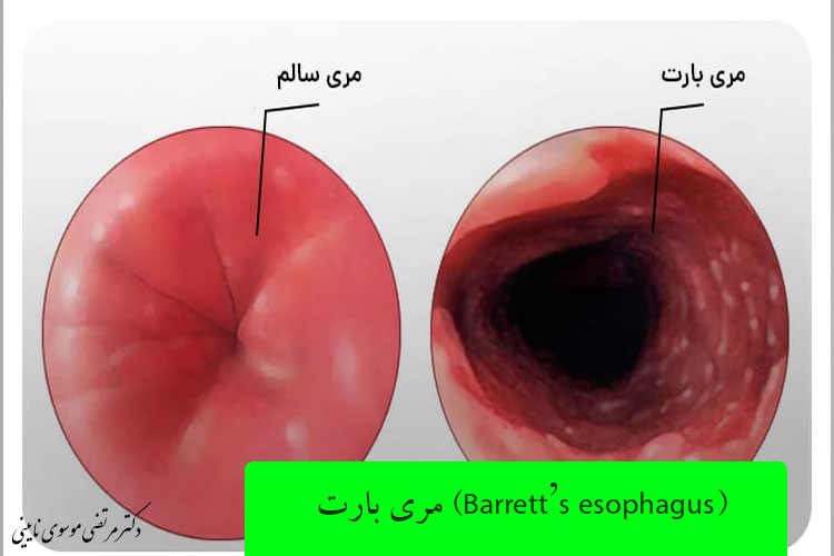 مری بارت (Barrett’s esophagus)