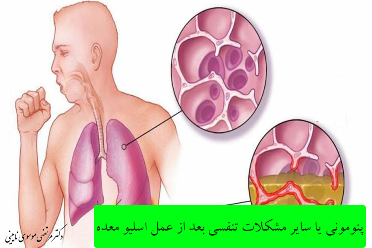 خطر آمبولی تا چند روز بعد از عمل اسلیو است