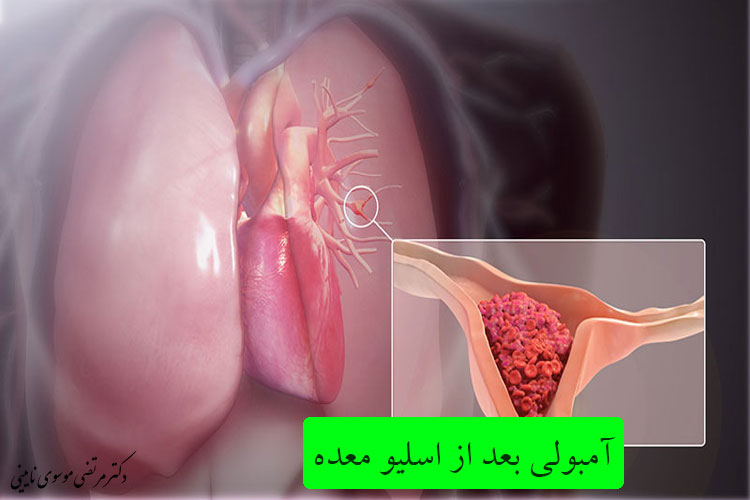 خطر آمبولی تا چند روز بعد از عمل اسلیو است